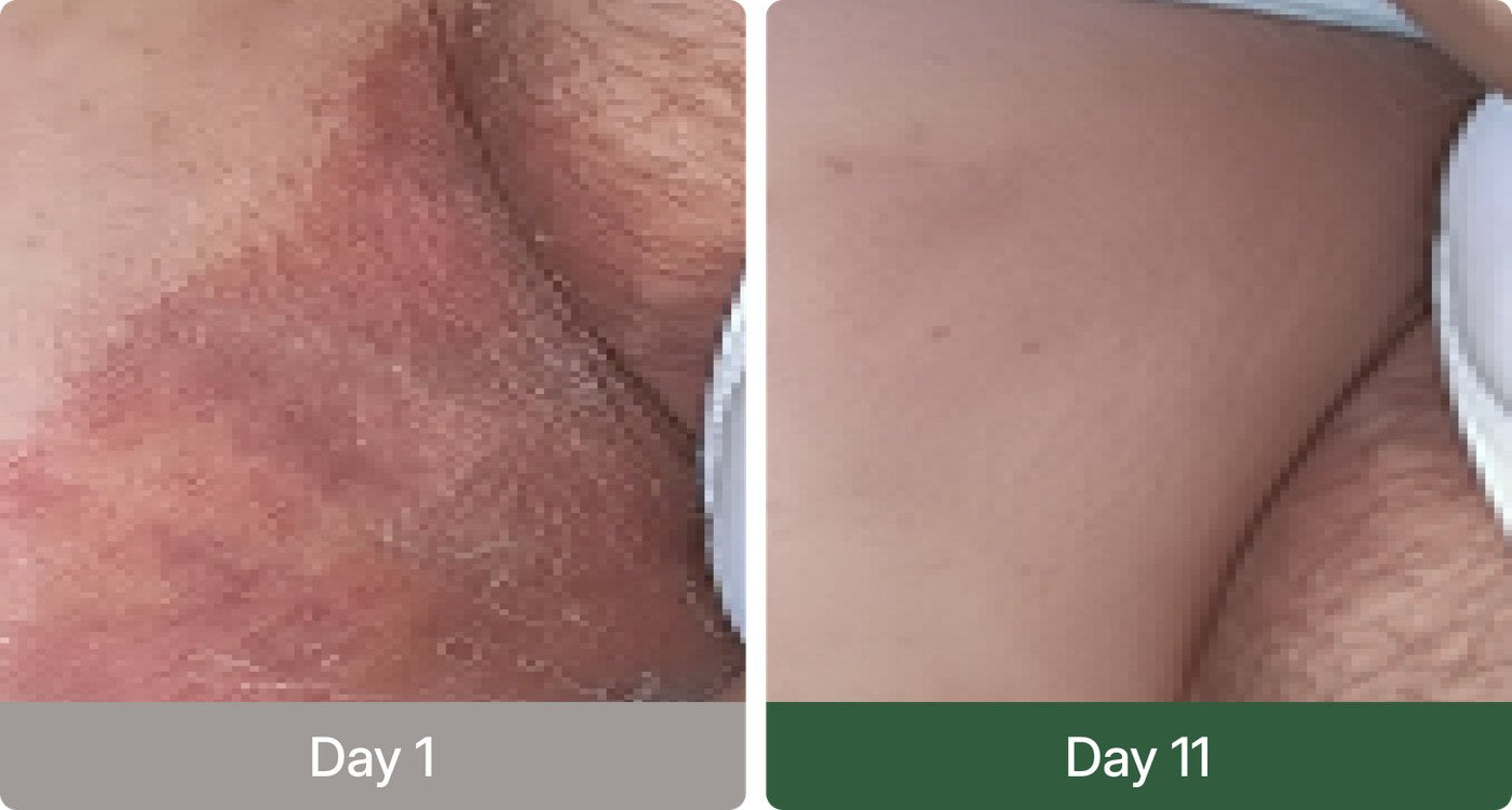 Day 1 versus day 11 before and after