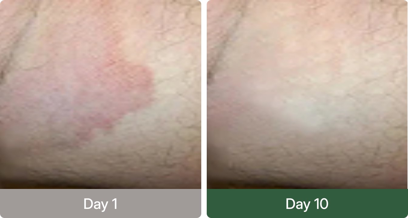 Day 1 versus day 10 before and after