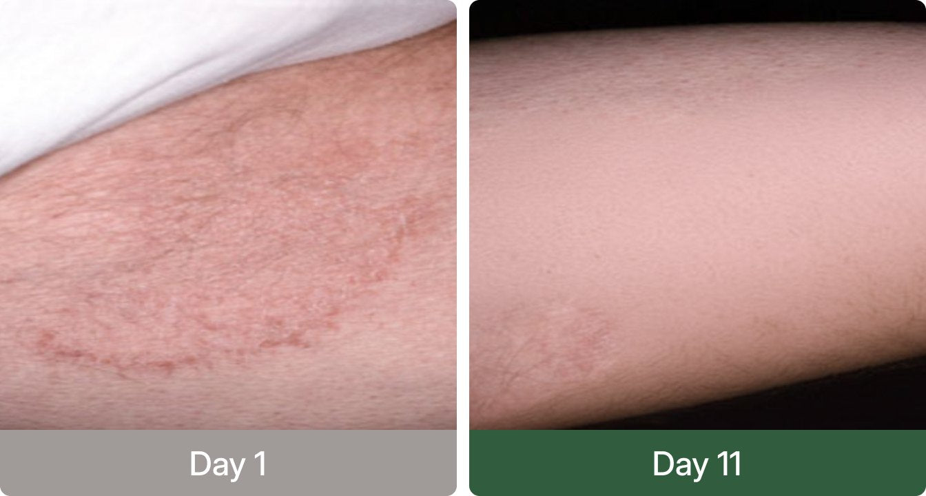 Day 1 versus day 11 before and after